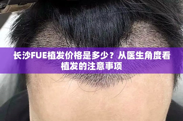 长沙FUE植发价格是多少？从医生角度看植发的注意事项