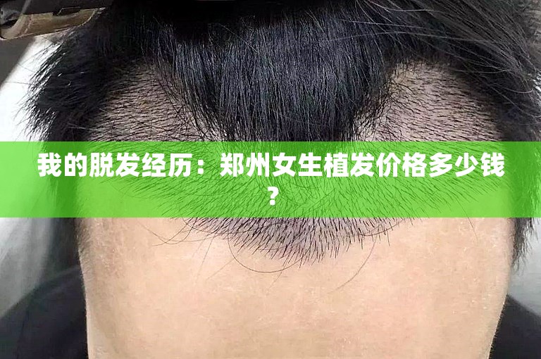 我的脱发经历：郑州女生植发价格多少钱？