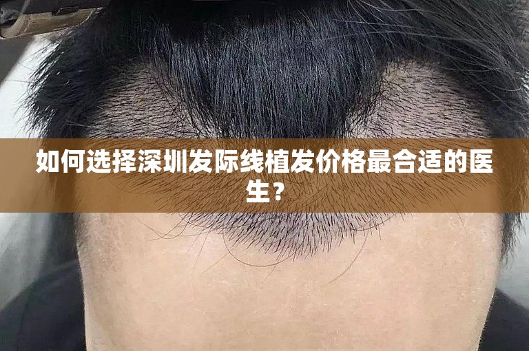 如何选择深圳发际线植发价格最合适的医生？