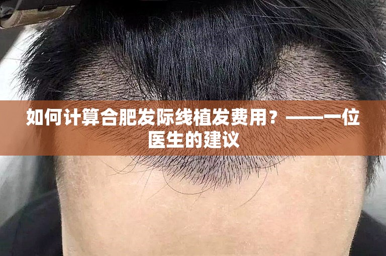 如何计算合肥发际线植发费用？——一位医生的建议