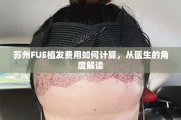 苏州FUE植发费用如何计算，从医生的角度解读