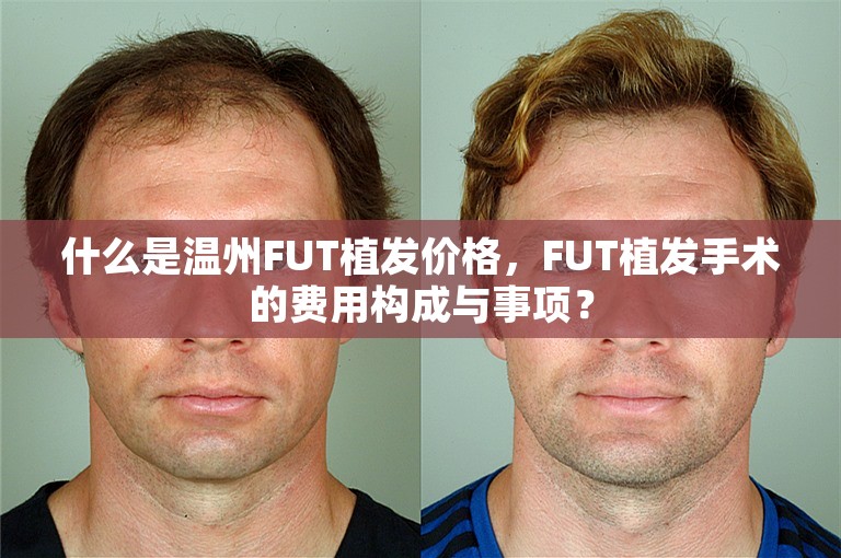 什么是温州FUT植发价格，FUT植发手术的费用构成与事项？