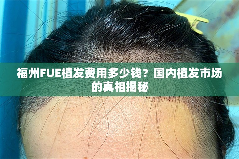 福州FUE植发费用多少钱？国内植发市场的真相揭秘