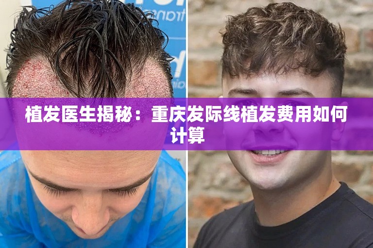 植发医生揭秘：重庆发际线植发费用如何计算