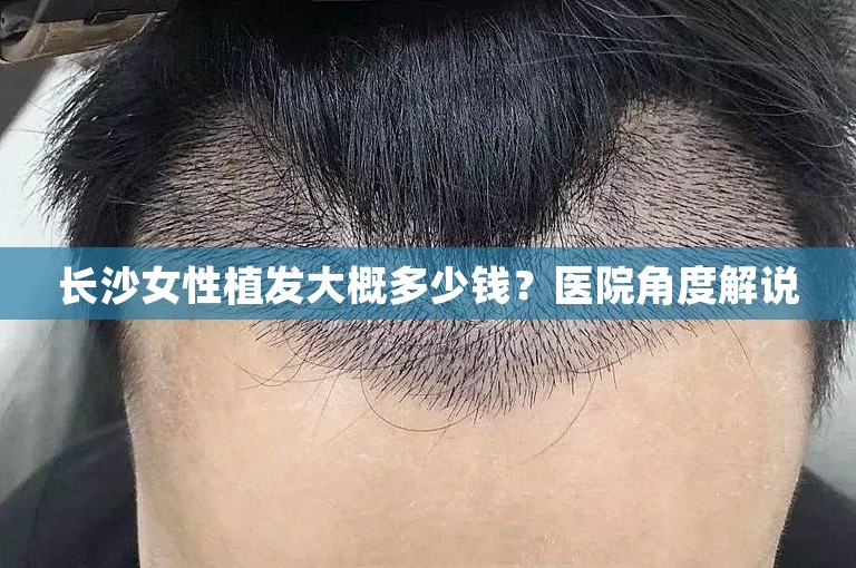 长沙女性植发大概多少钱？医院角度解说