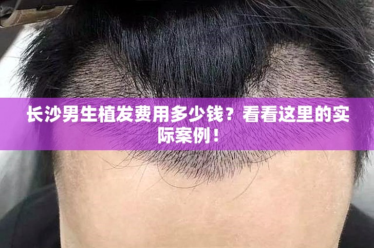 长沙男生植发费用多少钱？看看这里的实际案例！