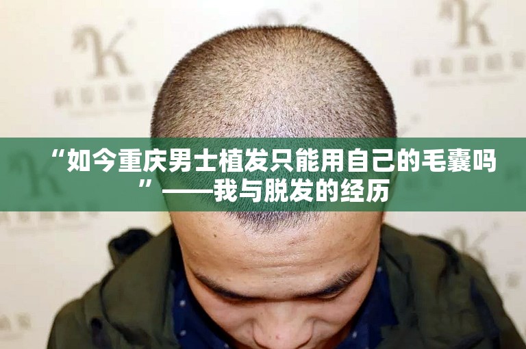 “如今重庆男士植发只能用自己的毛囊吗”——我与脱发的经历