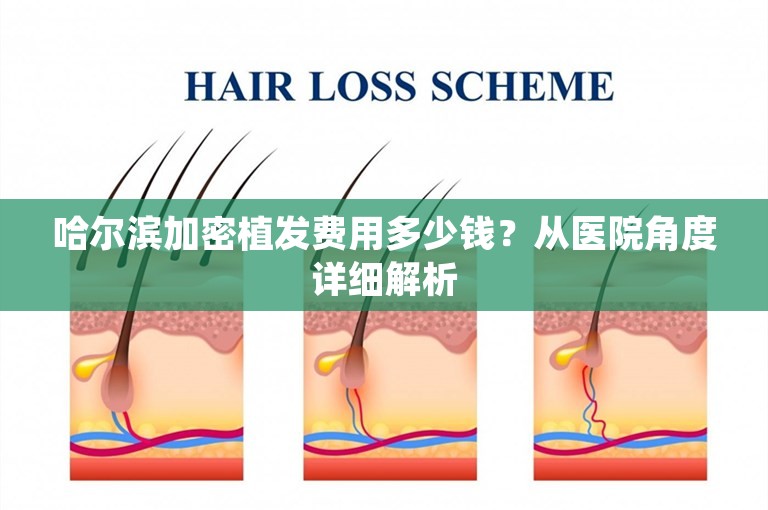 哈尔滨加密植发费用多少钱？从医院角度详细解析