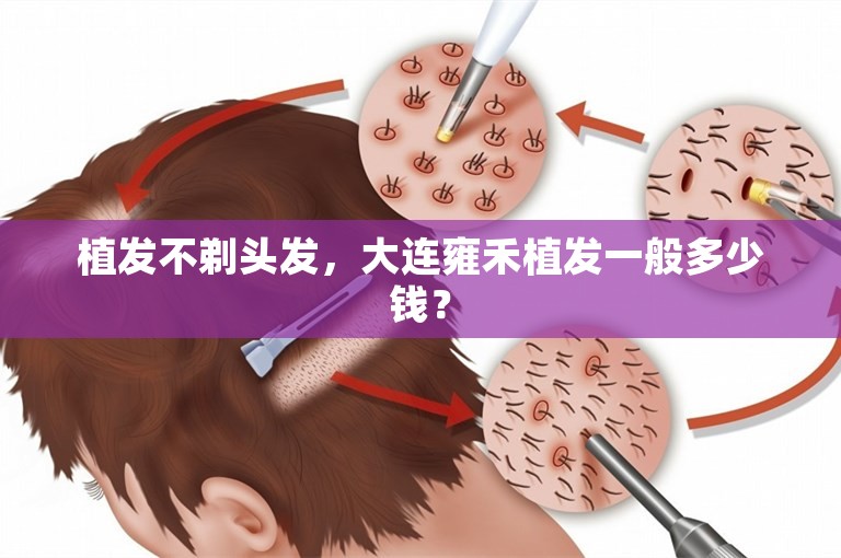 植发不剃头发，大连雍禾植发一般多少钱？