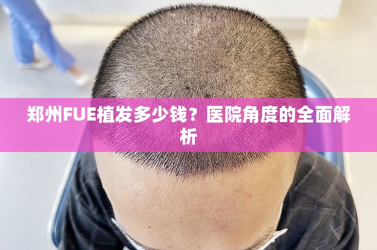 郑州FUE植发多少钱？医院角度的全面解析