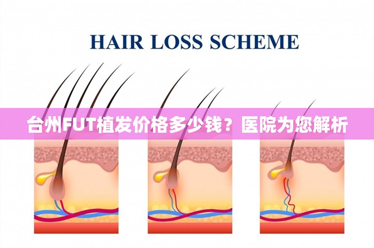 台州FUT植发价格多少钱？医院为您解析