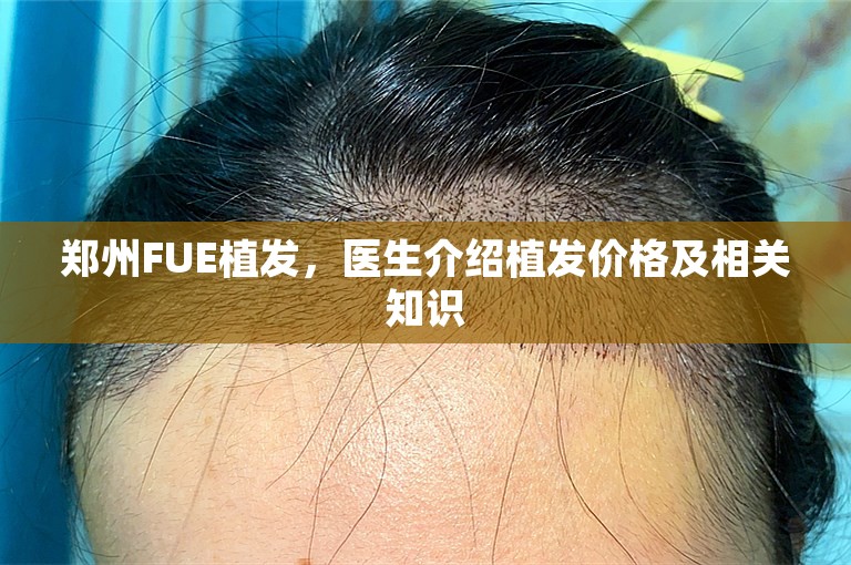 郑州FUE植发，医生介绍植发价格及相关知识