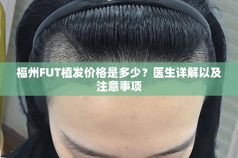 福州FUT植发价格是多少？医生详解以及注意事项