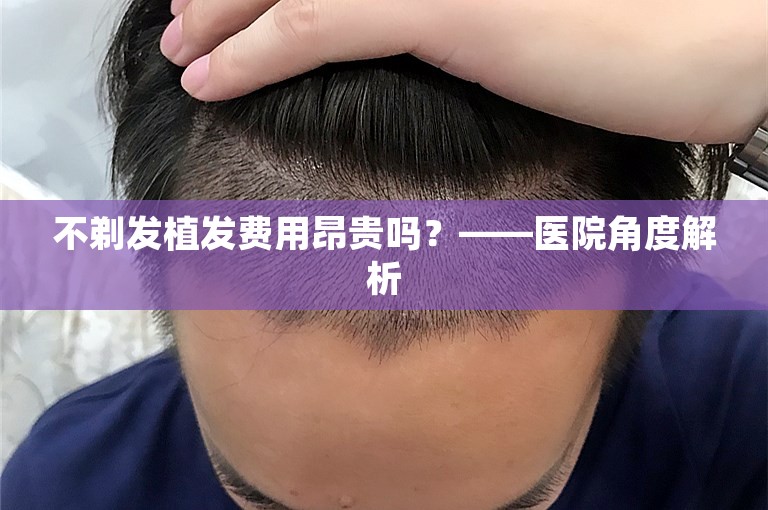 不剃发植发费用昂贵吗？——医院角度解析