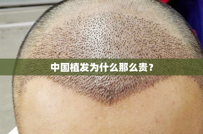 中国植发为什么那么贵？