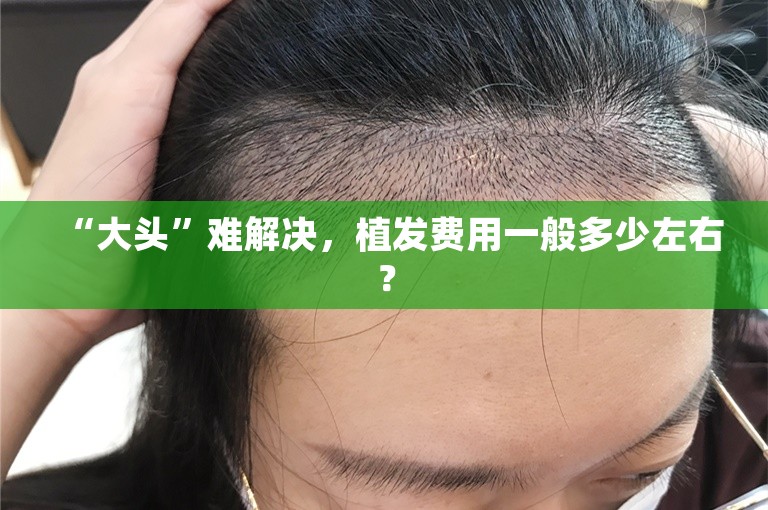 “大头”难解决，植发费用一般多少左右？