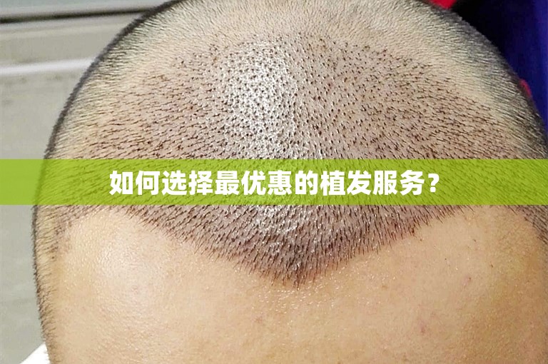 如何选择最优惠的植发服务？