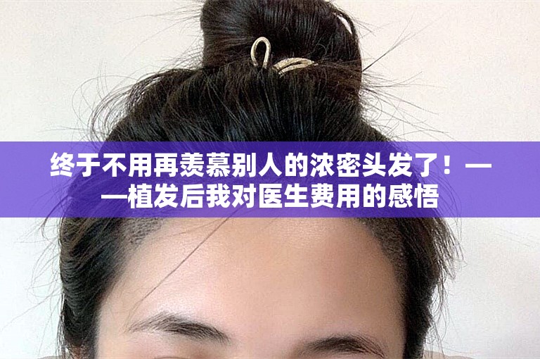 终于不用再羡慕别人的浓密头发了！——植发后我对医生费用的感悟