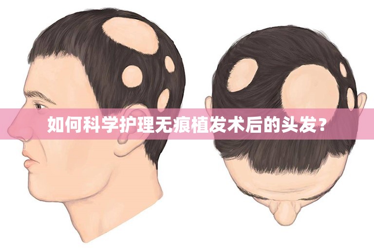 如何科学护理无痕植发术后的头发？