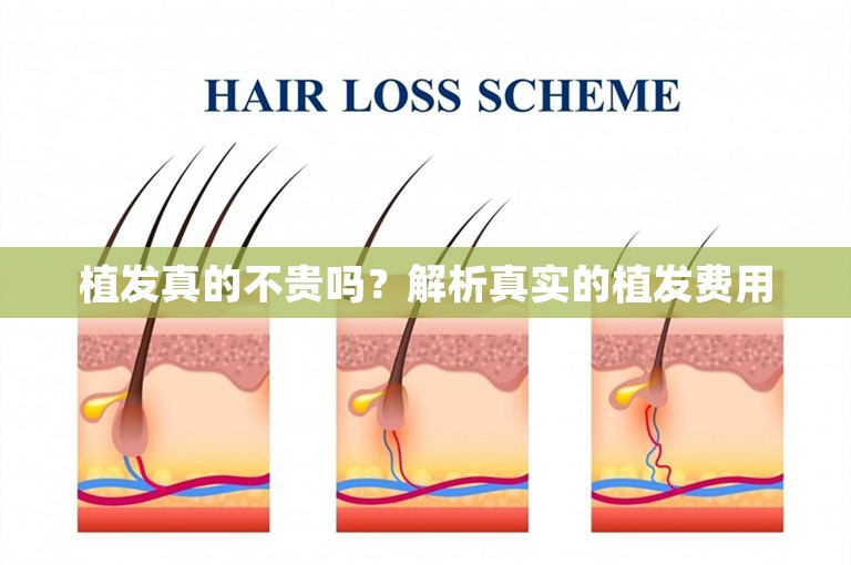 植发真的不贵吗？解析真实的植发费用