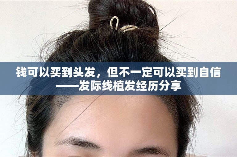 钱可以买到头发，但不一定可以买到自信——发际线植发经历分享