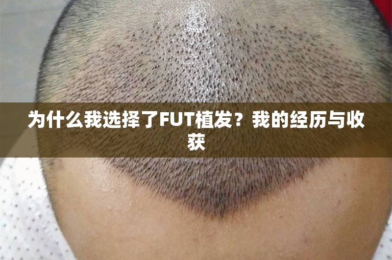 为什么我选择了FUT植发？我的经历与收获