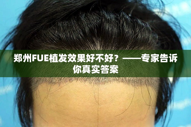 郑州FUE植发效果好不好？——专家告诉你真实答案