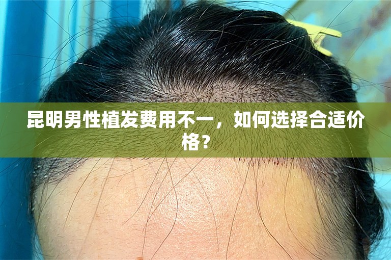 昆明男性植发费用不一，如何选择合适价格？