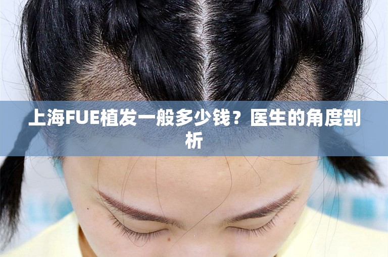 上海FUE植发一般多少钱？医生的角度剖析