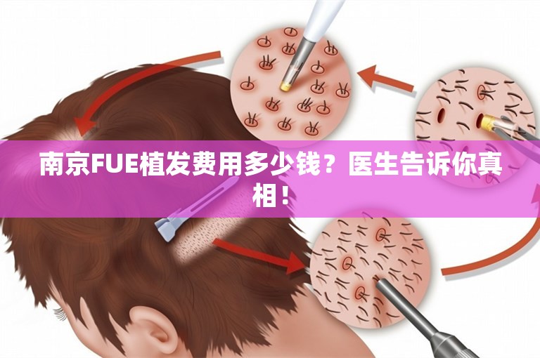 南京FUE植发费用多少钱？医生告诉你真相！