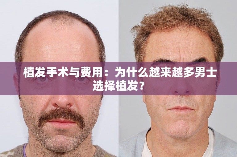  植发手术与费用：为什么越来越多男士选择植发？