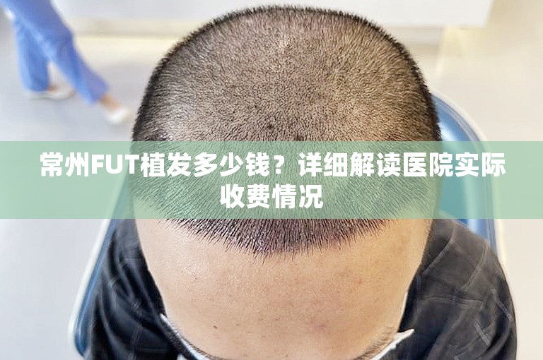 常州FUT植发多少钱？详细解读医院实际收费情况