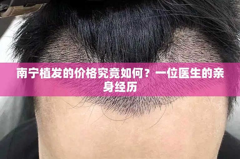 南宁植发的价格究竟如何？一位医生的亲身经历