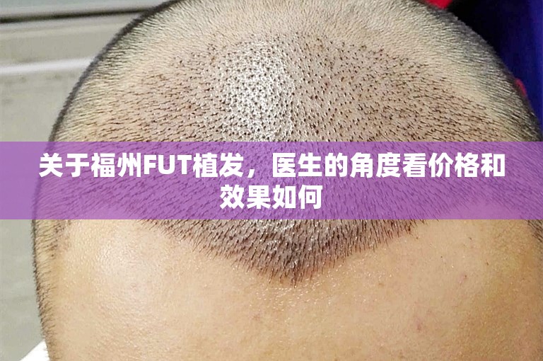 关于福州FUT植发，医生的角度看价格和效果如何