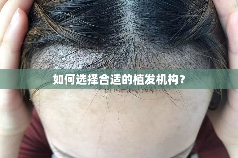 如何选择合适的植发机构？