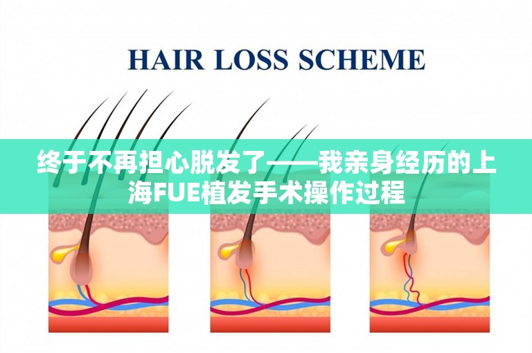 终于不再担心脱发了——我亲身经历的上海FUE植发手术操作过程