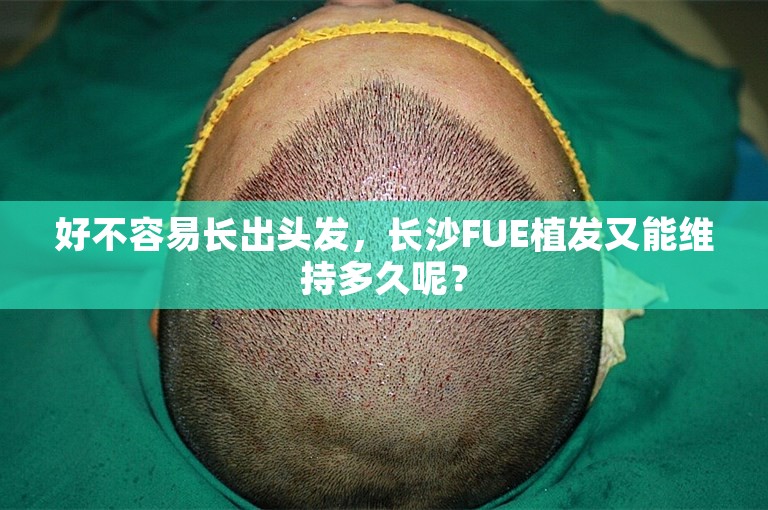 好不容易长出头发，长沙FUE植发又能维持多久呢？