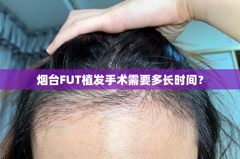 烟台FUT植发手术需要多长时间？