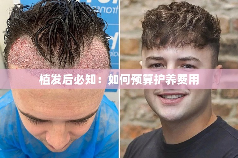 植发后必知：如何预算护养费用