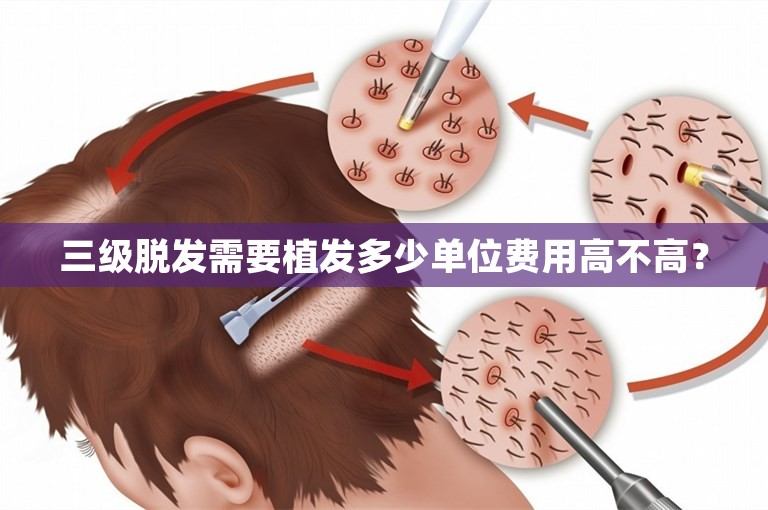 三级脱发需要植发多少单位费用高不高？