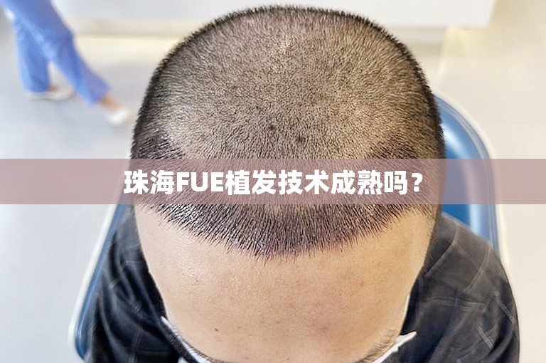 珠海FUE植发技术成熟吗？