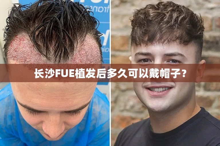 长沙FUE植发后多久可以戴帽子？