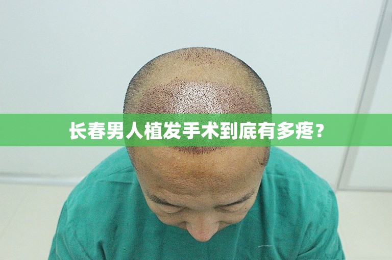 长春男人植发手术到底有多疼？