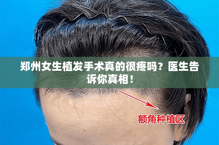 郑州女生植发手术真的很疼吗？医生告诉你真相！