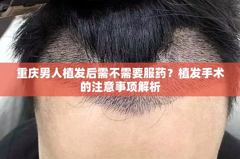 重庆男人植发后需不需要服药？植发手术的注意事项解析