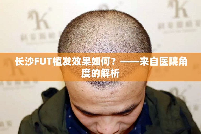 长沙FUT植发效果如何？——来自医院角度的解析