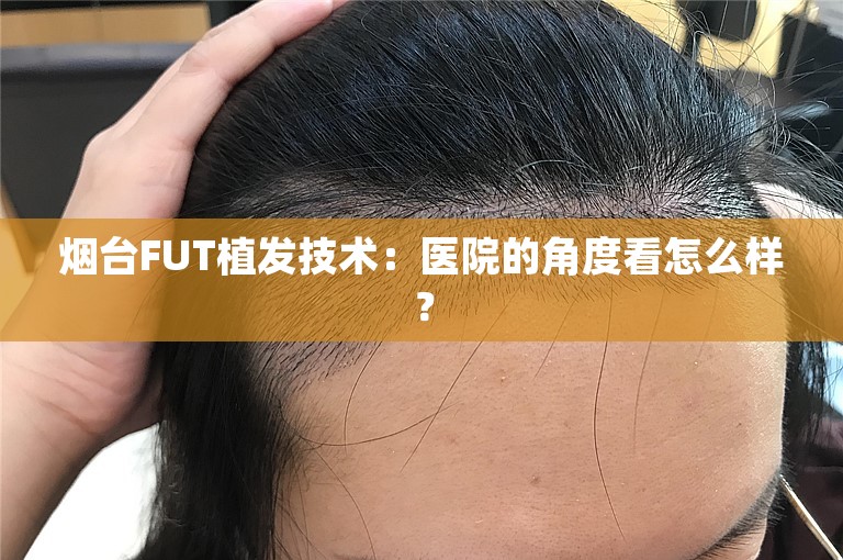 烟台FUT植发技术：医院的角度看怎么样？