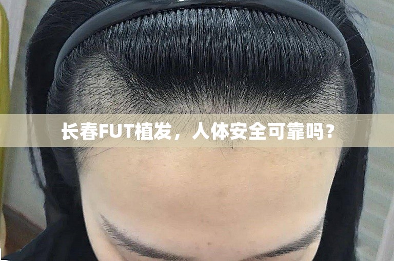 长春FUT植发，人体安全可靠吗？