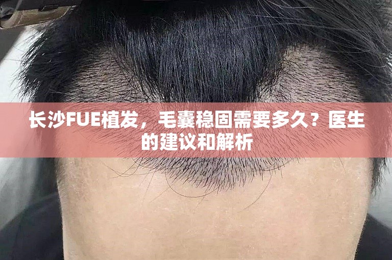 长沙FUE植发，毛囊稳固需要多久？医生的建议和解析