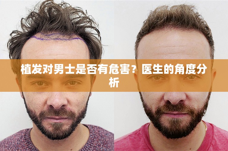 植发对男士是否有危害？医生的角度分析